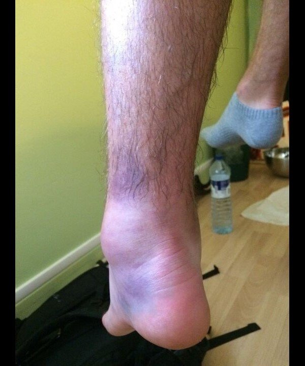 ankel (After) 3 sessions in a day ​