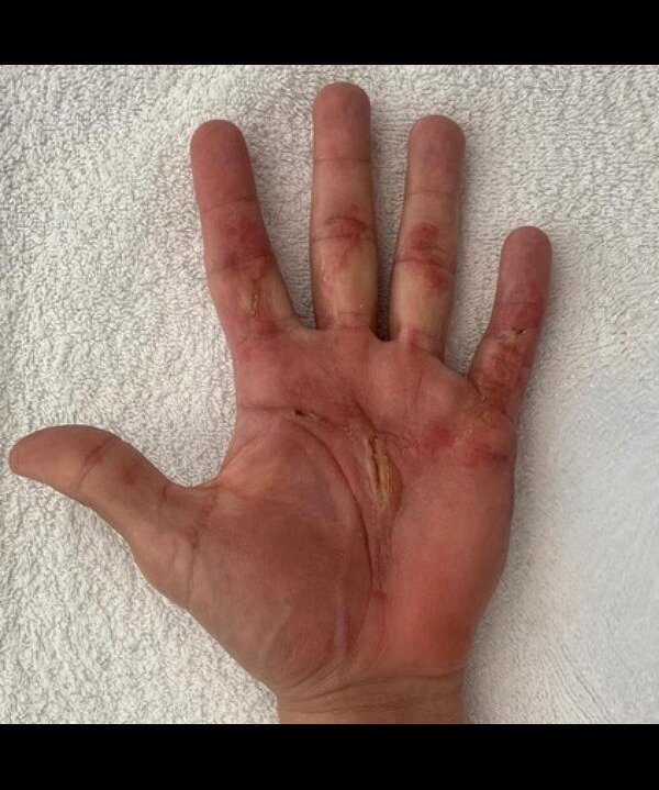 Surgical Scar (After)