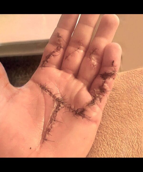 Surgical Scar (Before)