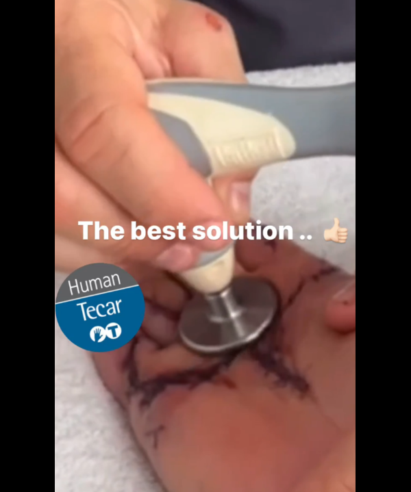 Surgical Scar (within session)