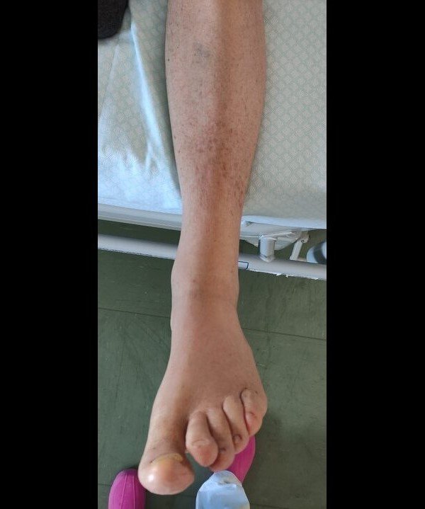 Lymphedema (After one session)