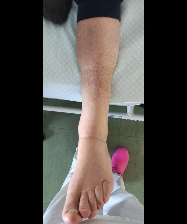 Lymphedema (Before)
