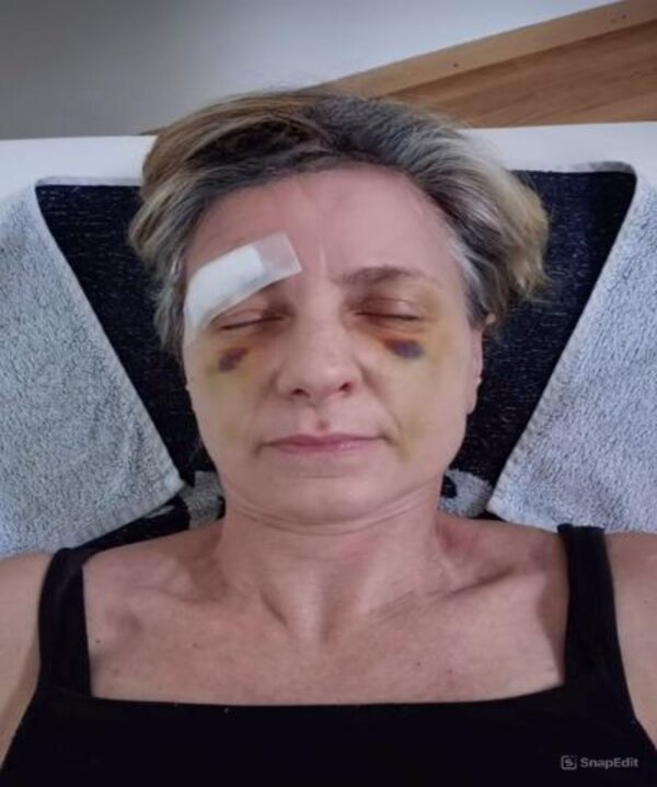Face (Before)