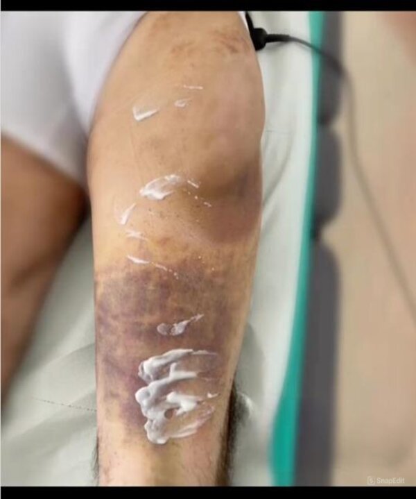 Bruises (Before)