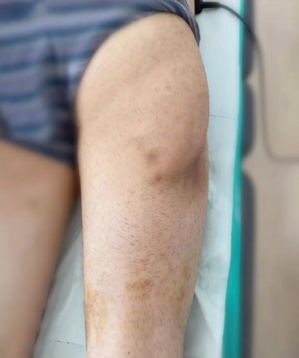 Bruises (After 4 session)