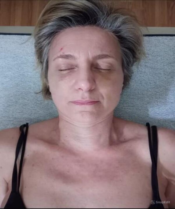 Face (After 2 session )