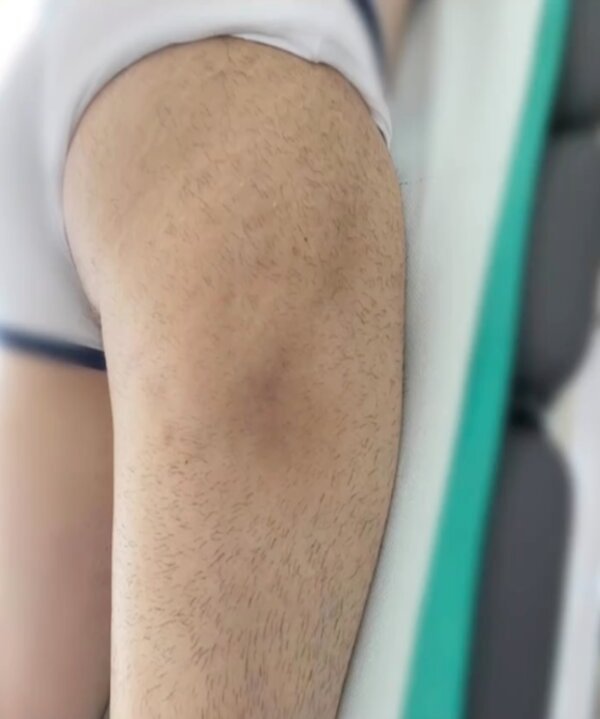 Bruises (After 5 session)