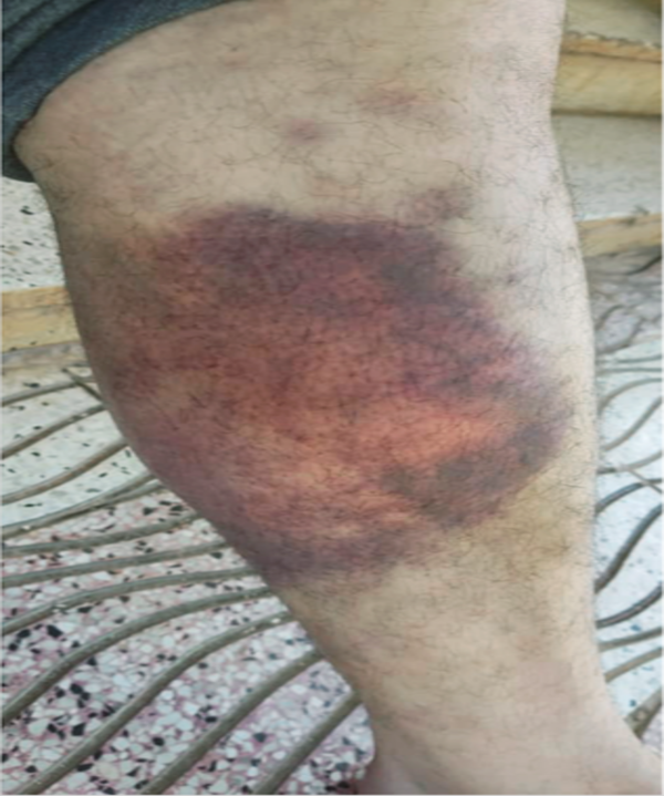 Bruises (Before)