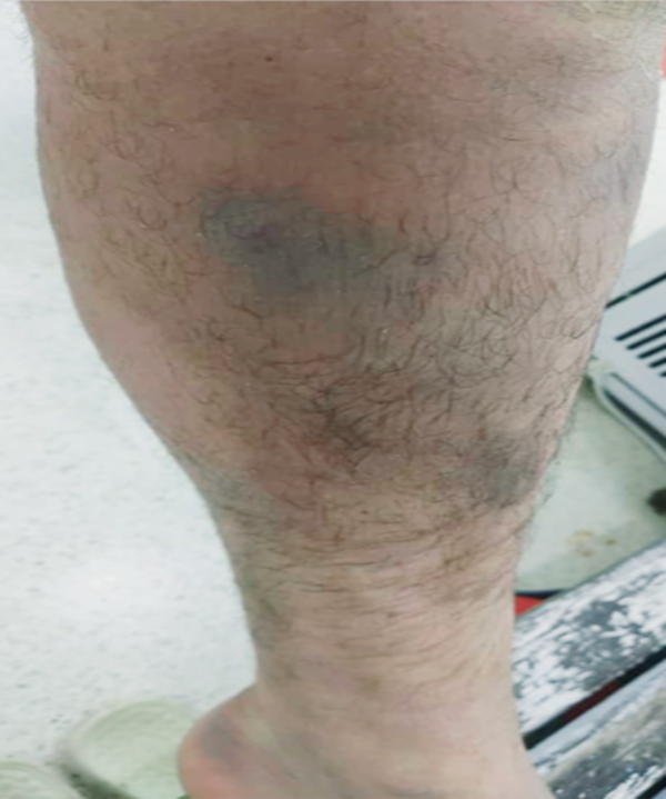 Bruises ( After 7 session)